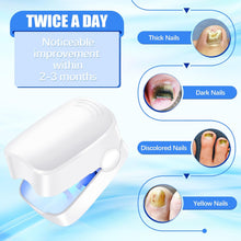 Rechargeable Nail Fungus Laser – Anti-Fungal Device Toenails, Hands & Feet (Home Use)